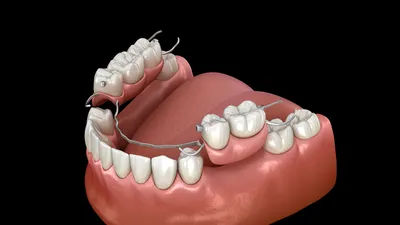Съемные протезы: их роль при восстановлении улыбки и функции зубов