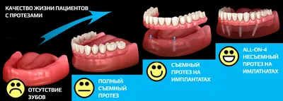Съемные протезы зубов, цена в Ульяновске