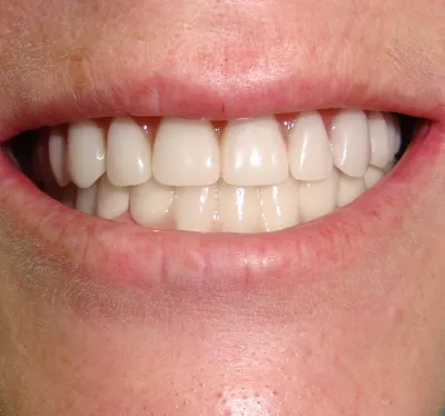 Съёмные зубные протезы, плюсы и минусы использования зубных протезов на  присосках. | НоваДент