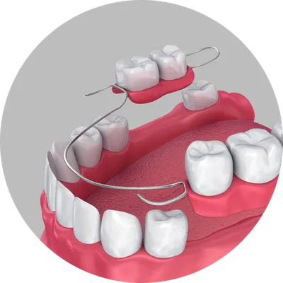 Съемные и условно-съемные зубные протезы на имплантах: виды, плюсы и  минусы, отзывы.