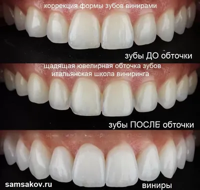 Стриппинг, сепарация – вредно ли «подпиливание» зубов?