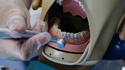 Межзубная сепарация зубов