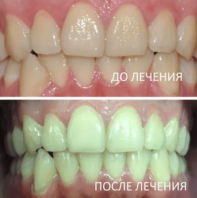 Сколько носят брекеты на зубах – минимальный и максимальный срок