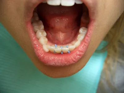 Сепарация зубов: преимущества, показания, осложнения
