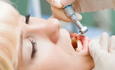 Технические нюансы ортодонтического лечения: Лассо. - интересно об  ортодонтии, имплантации и протезировании зубов