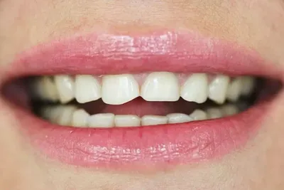Сепарация зубов: что это и когда применяют