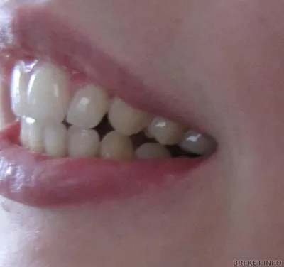 Шатание зубов в брекет системах
