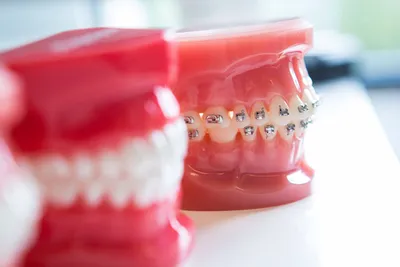 Сепарация зубов при ношении брекетов — альтернатива удалению зубов