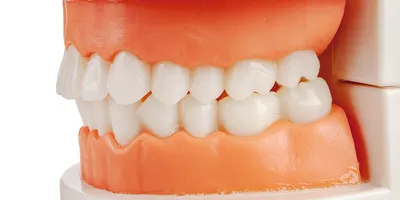 Сепарация зубов | Дневник пользователя Lucida | Брекет.Info