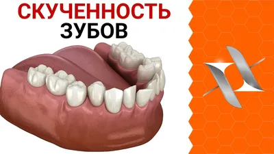 Пример из портфолио: исправление кривизны зубного ряда верхней и нижней  челюсти