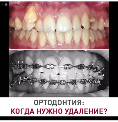 КОГДА НУЖНО УДАЛЕНИЕ? | Спасибо.Клиник | Дзен