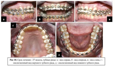 Исправление скученности зубов брекетами или элайнерами у взрослых