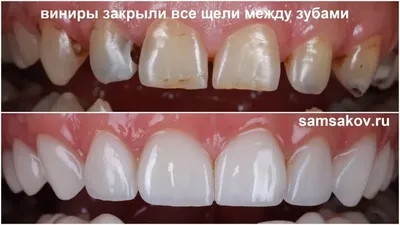Ортогнатический прикус зубов - виды, признаки, характеристика