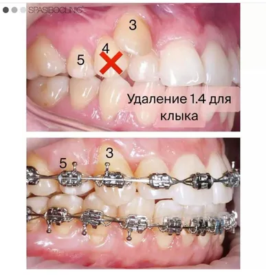 Сверхкомплектные зубы в ортодонтии