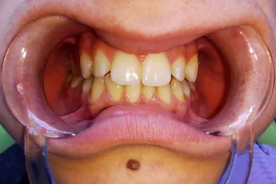 Прозрачные элайнеры и аппроксимальная сепарация зубов