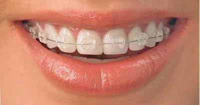 Кривые зубы у детей и взрослых - причины, как исправить, что делать, если  зуб растет криво