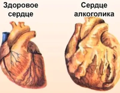 Сердце здорового человека и страдающего алкоголизмом | Пикабу