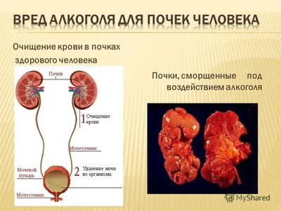 Какие заболевания вызывает алкоголь и как алкоголизм в целом влияет на  человека, последствия употребления