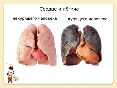 Tomex.kg - Курение и рентген легких 🚭 ❗Курильщики, это пост для вас!  ⚠️Курение ведёт к изменениям в легочной ткани,а соответсвенно вредит  здоровью. А теперь разберёмся, что мы видим на рентгенограммах легких:  легкие