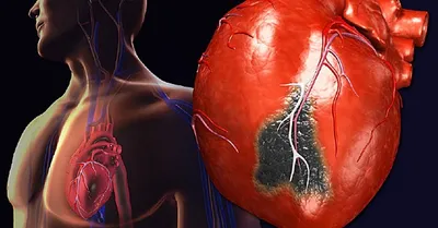 Жизнь сердца после инфаркта | От чистого сердца ❤️ Ваш персональный  кардиолог | Дзен