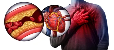 Инфаркт миокарда: симптомы, лечение, признаки острого инфаркта миокарда,  формы и диагностика