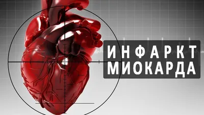 Сколько живут после инфаркта