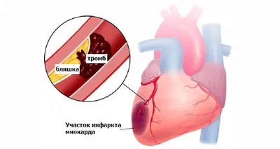 При инсульте и инфаркте очень важно вовремя получить экстренную помощь -  Российская газета