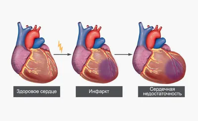 Половина случаев инфарктов миокарда остаётся незамеченной - Национальная  бариатрическая практика