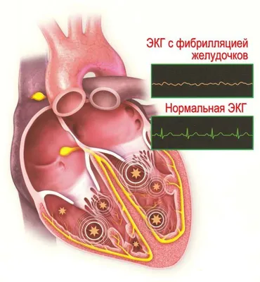 Плановое и экстренное коронарное шунтирование в Израиле : Armedical