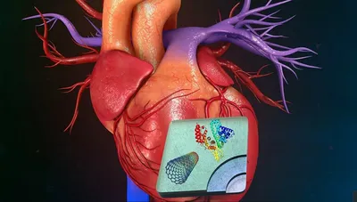 Инфаркт - причины и симптомы
