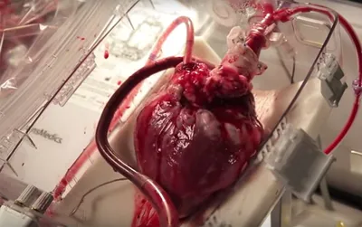 Создали «пластырь» для восстановления сердца после инфаркта