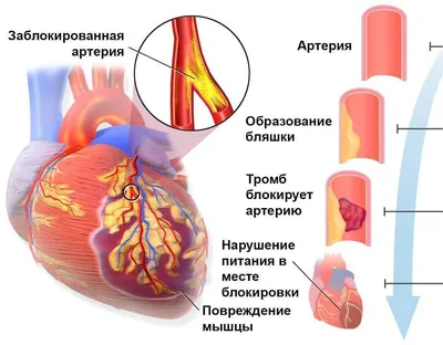 Сердце при инфаркте фото фото