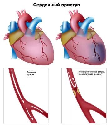Инфаркт миокарда: симптомы, лечение, признаки острого инфаркта миокарда,  формы и диагностика
