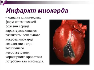 Аневризма сердца: симптомы, диагностика, лечение. Осложнения аневризмы  сердца