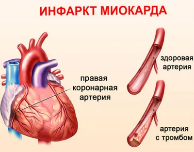 Вот такой рубец!»: что нужно знать об инфаркте миокарда?