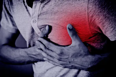 Инфаркт миокарда - это нарушение кровообращения в коронарных артериях.