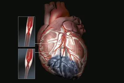 Ишемическая болезнь сердца: причины, симптомы, факторы риска, методы  диагностики и лечения