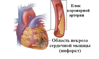 Инфаркт миокарда | Südamekeskus