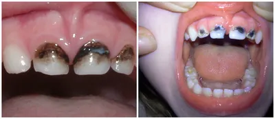 Серебрение зубов фото до и после фото
