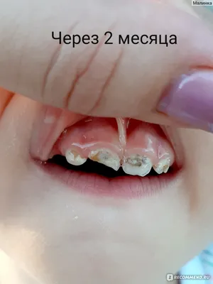 Серебрение молочных зубов у детей - «Делать или нет? Больше месяца  взвешивала все \"за\" и \"против\". Дополнила отзыв об неудачном серебрении  младшему сыну. Плюс фото зубов старшего ребенка перед удалением серебренных  зубов» |