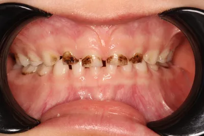 Серебрение молочных зубов у детей - «Серебрение зубов детей, все плюсы и  минусы. Отзыв об укреплении при дисплазии эмали и что нам еще помогло.  Какой препарат лучше использовать. Результат спустя год» | отзывы
