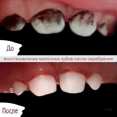 Восстановление молочных зубов после серебрения. | Детская стоматология  \"Щелкунчик\" | Дзен
