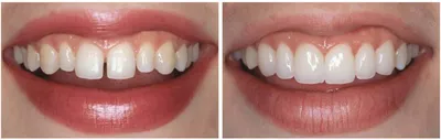 Серебрение зубов: чего опасаться? | Стоматология Atribeaute Kids | Дзен