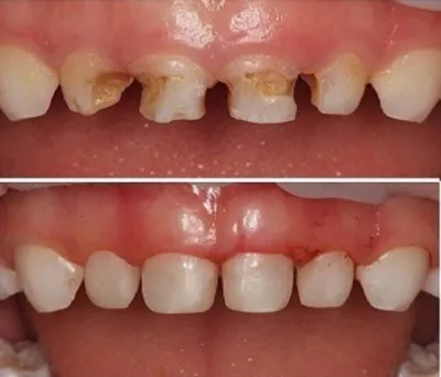 Кривые зубы – фото, как исправить