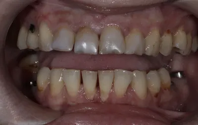Плохие молочные зубы: причины – статьи детской стоматологической клиники  «Мартинка»