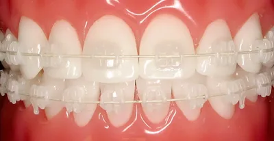 Циркониевые коронки для зубов: сколько стоит - фото до и после