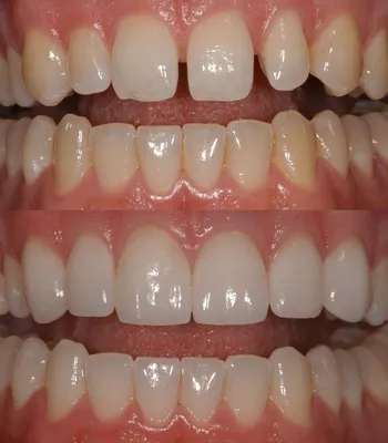 Дистопия зуба до/после в Уфе | ☎ +7 (347) 295-94-77