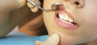 Щель между передними зубами | Статьи | Стоматология Ас-Стом в  Санкт-Петербурге