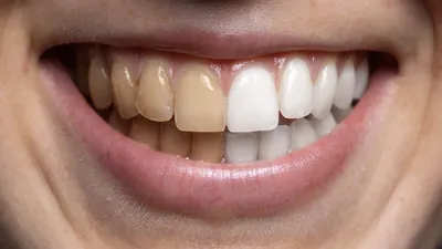 Опасно ли отбеливание зубов Zoom 4?