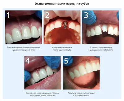 Гигиена зубов после отбеливания - Как сохранить результат